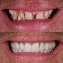 Carillas Dentales - AM Estética Dental