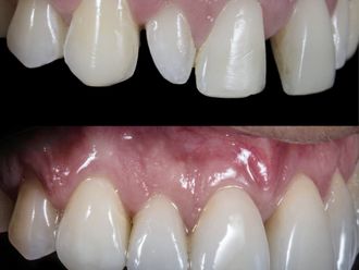 Carillas dentales antes y después - 880467