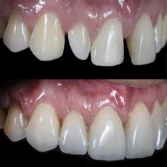 Carillas Dentales - AM Estética Dental