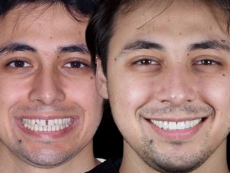 Carillas dentales antes y después - 880468