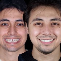 Carillas Dentales - AM Estética Dental