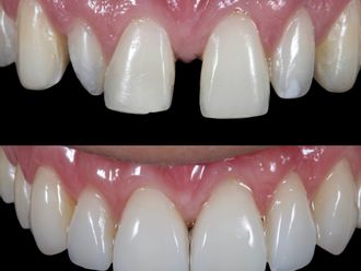Carillas dentales antes y después - 880469