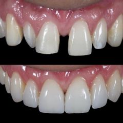 Carillas Dentales - AM Estética Dental