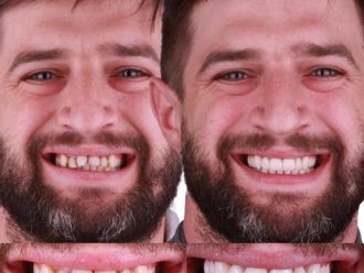 Carillas dentales antes y después - 880473