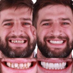 Carillas Dentales - AM Estética Dental