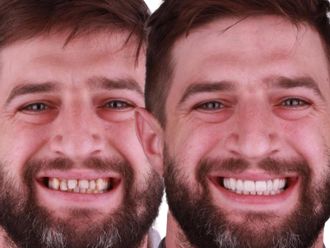 Carillas dentales antes y después - 880474