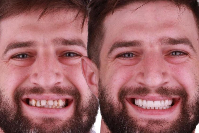 Carillas dentales antes y después - 880474