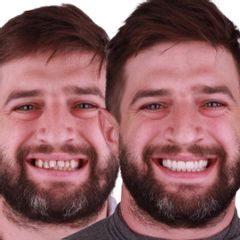 Carillas Dentales - AM Estética Dental
