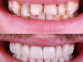 Carillas dentales antes y después - 880475