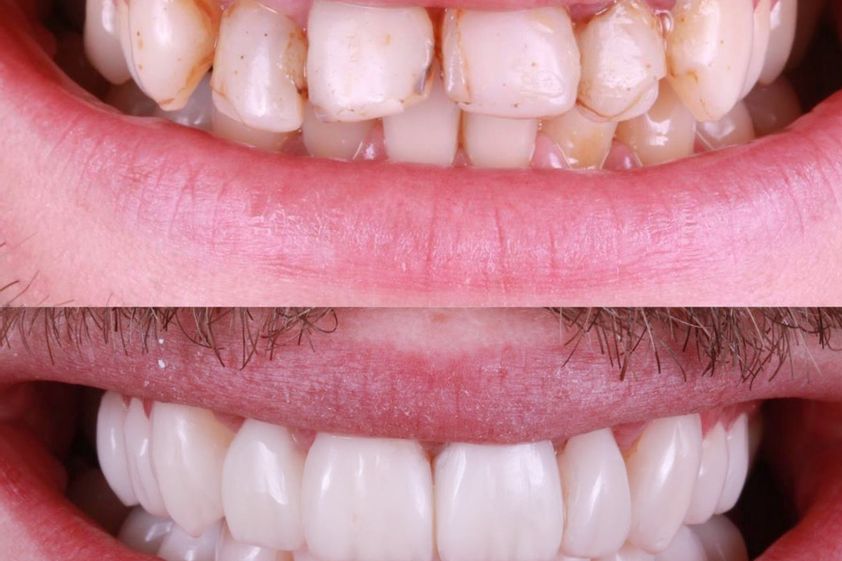 Carillas dentales antes y después - 880475