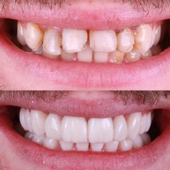 Carillas Dentales - AM Estética Dental