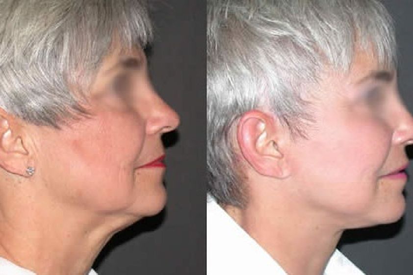 Rejuvenecimiento facial antes y después - 280749