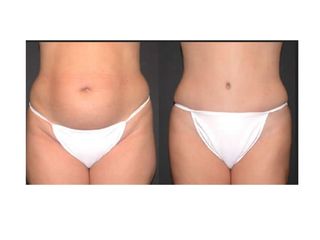 Abdominoplastia