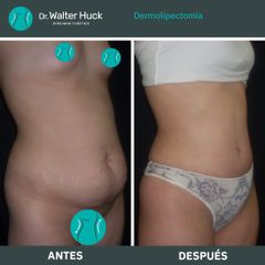 Dermolipectomía - Dr. Walter Gabriel Huck - Centro Médico Alvear
