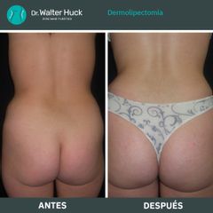 Dermolipectomía - Dr. Walter Gabriel Huck - Centro Médico Alvear