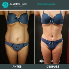 Dermolipectomía - Dr. Walter Gabriel Huck - Centro Médico Alvear