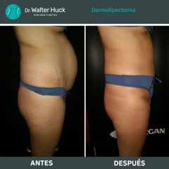 Dermolipectomía - Dr. Walter Gabriel Huck - Centro Médico Alvear