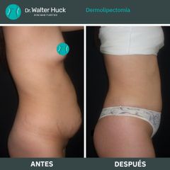 Dermolipectomía - Dr. Walter Gabriel Huck - Centro Médico Alvear