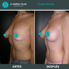 Aumento mamas  - Dr. Walter Gabriel Huck - Centro Médico Alvear