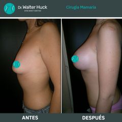 Aumento mamas  - Dr. Walter Gabriel Huck - Centro Médico Alvear