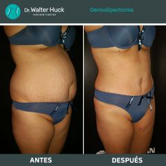 Dermolipectomía - Dr. Walter Gabriel Huck - Centro Médico Alvear