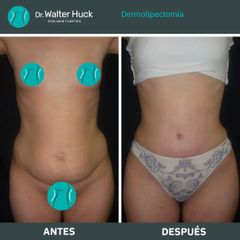 Dermolipectomía - Dr. Walter Gabriel Huck - Centro Médico Alvear