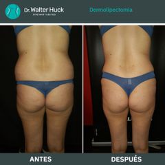 Dermolipectomía - Dr. Walter Gabriel Huck - Centro Médico Alvear