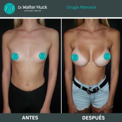 Aumento mamas  - Dr. Walter Gabriel Huck - Centro Médico Alvear