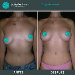 Aumento mamas  - Dr. Walter Gabriel Huck - Centro Médico Alvear