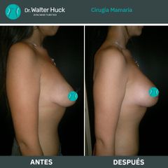 Aumento mamas  - Dr. Walter Gabriel Huck - Centro Médico Alvear