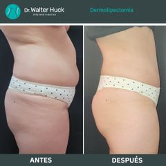 Dermolipectomía - Dr. Walter Gabriel Huck - Centro Médico Alvear