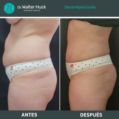 Dermolipectomía - Dr. Walter Gabriel Huck - Centro Médico Alvear