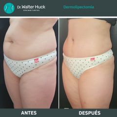 Dermolipectomía - Dr. Walter Gabriel Huck - Centro Médico Alvear