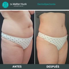 Dermolipectomía - Dr. Walter Gabriel Huck - Centro Médico Alvear