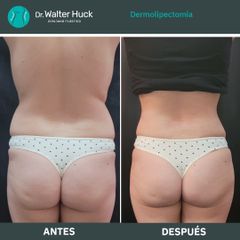 Dermolipectomía - Dr. Walter Gabriel Huck - Centro Médico Alvear