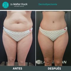 Dermolipectomía - Dr. Walter Gabriel Huck - Centro Médico Alvear