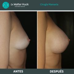 Aumento mamas  - Dr. Walter Gabriel Huck - Centro Médico Alvear