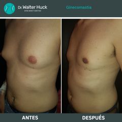 Ginecomastia - Dr. Walter Gabriel Huck - Centro Médico Alvear