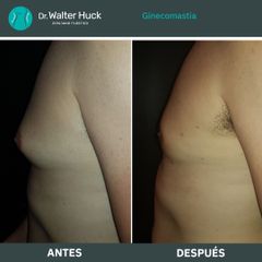 Ginecomastia - Dr. Walter Gabriel Huck - Centro Médico Alvear