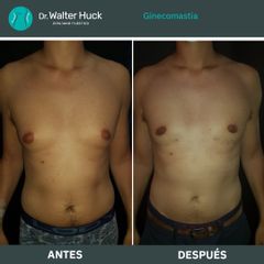 Ginecomastia - Dr. Walter Gabriel Huck - Centro Médico Alvear
