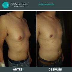 Ginecomastia - Dr. Walter Gabriel Huck - Centro Médico Alvear