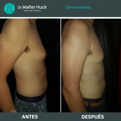 Ginecomastia - Dr. Walter Gabriel Huck - Centro Médico Alvear