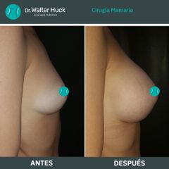 Aumento mamas  - Dr. Walter Gabriel Huck - Centro Médico Alvear