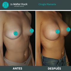 Aumento mamas  - Dr. Walter Gabriel Huck - Centro Médico Alvear