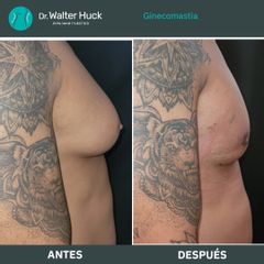 Ginecomastia - Dr. Walter Gabriel Huck - Centro Médico Alvear