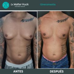 Ginecomastia - Dr. Walter Gabriel Huck - Centro Médico Alvear