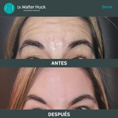 Botox - Dr. Walter Gabriel Huck - Centro Médico Alvear