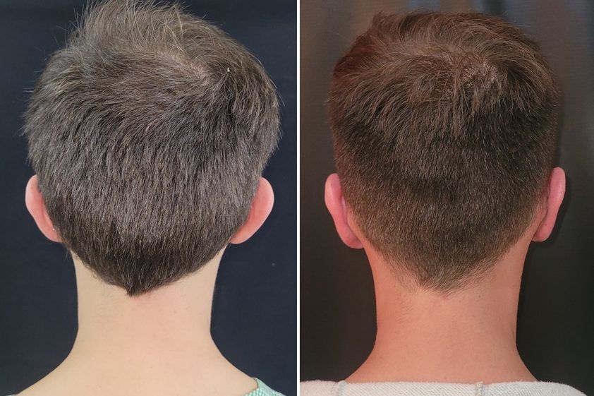 Otoplastia antes y después - 863511