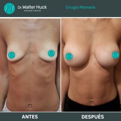 Aumento mamas - Dr. Walter Gabriel Huck - Centro Médico Alvear