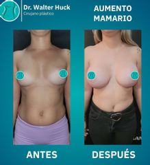 Aumento Mamario - Dr.  Walter Gabriel Huck - Centro Médico Alvear
